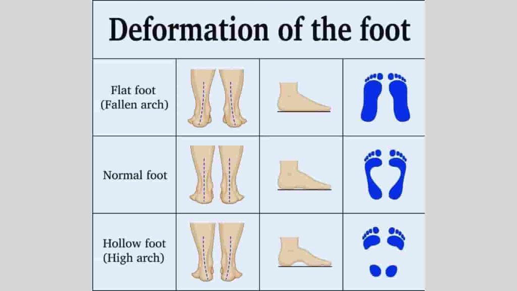 deformation of the foot